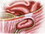 In men, the inguinal canal contains blood vessels that supply the testes, as well as the vessel that carries sperm to the penis. Hernias that occur due to a weakness in the abdominal wall at the inguinal canal, are called inguinal hernias.