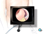 Once in place, the laparoscope will provide video images,