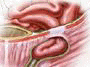 In men, the inguinal canal contains blood vessels that supply the testes, as well as the vessel that carries sperm to the penis. Hernias that occur due to a weakness in the abdominal wall at the inguinal canal, are called inguinal hernias. And not surprisingly, men are 25 times more likely than women to experience a hernia in this area.
