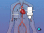 During the time that your heart is not beating, a special machine, called a heart-lung machine, will take over the job of circulating and oxygenating your blood.