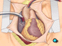 ... and a second tube is placed into the right atrium of the heart.