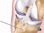 The ligament graft is then inserted into place.