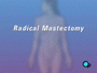 In the case of any form of mastectomy as a treatment for cancer,