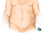Then, when you are asleep, the surgical team will make an incision just above the navel.