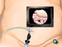 Once in place, the laparoscope will provide video images that allow the surgeon to see the inside of your abdomen.