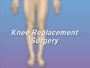 You doctor has recommended that you undergo knee replacement surgery. But what exactly does that mean?